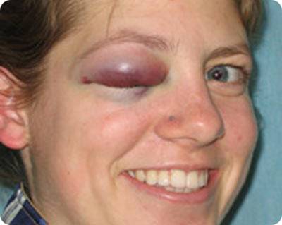 Swollen black eye deals